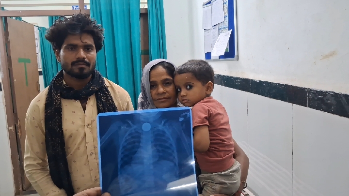 छतरपुर: 3 साल के बच्चे के गले से डॉक्टर ने निकाला सिक्का